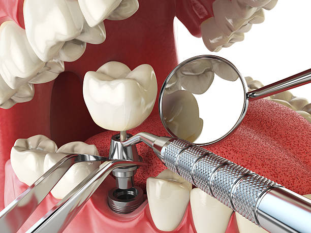Best Knocked-Out Tooth (Avulsed Tooth) Treatment in Archer, FL